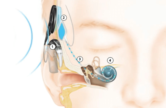 Implantes Auditivos y Cocleares