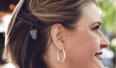 Implantes Osteointegrados